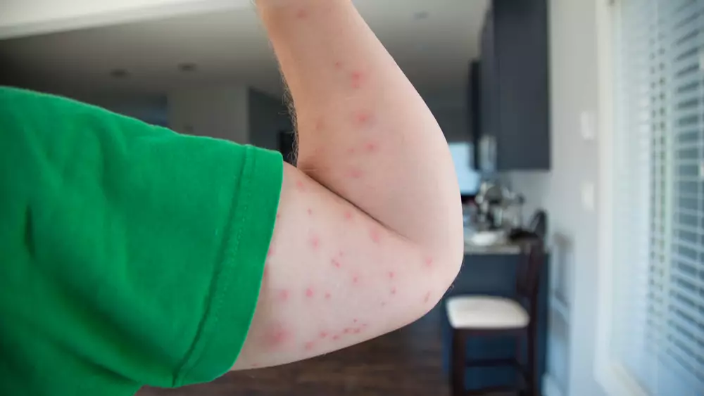 many bed bug bites on a person's arm