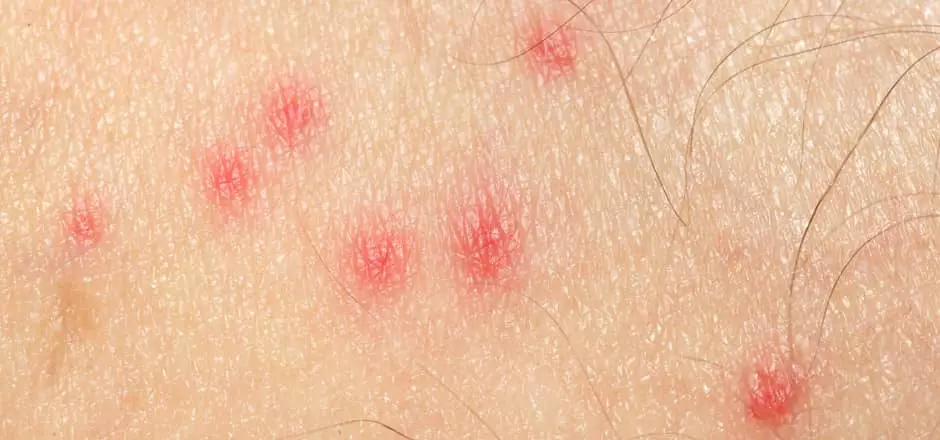 photo of bed bug bites