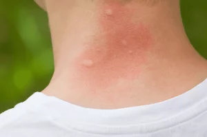 photo of mosquito bites