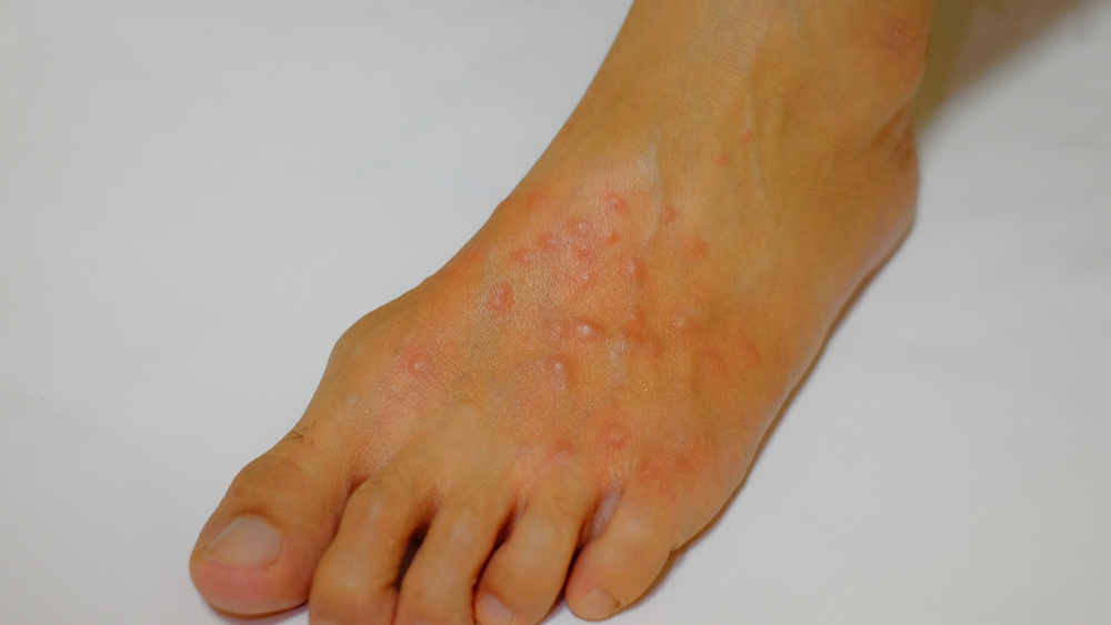 Fire ant stings on a foot preventable with fire ant treatments